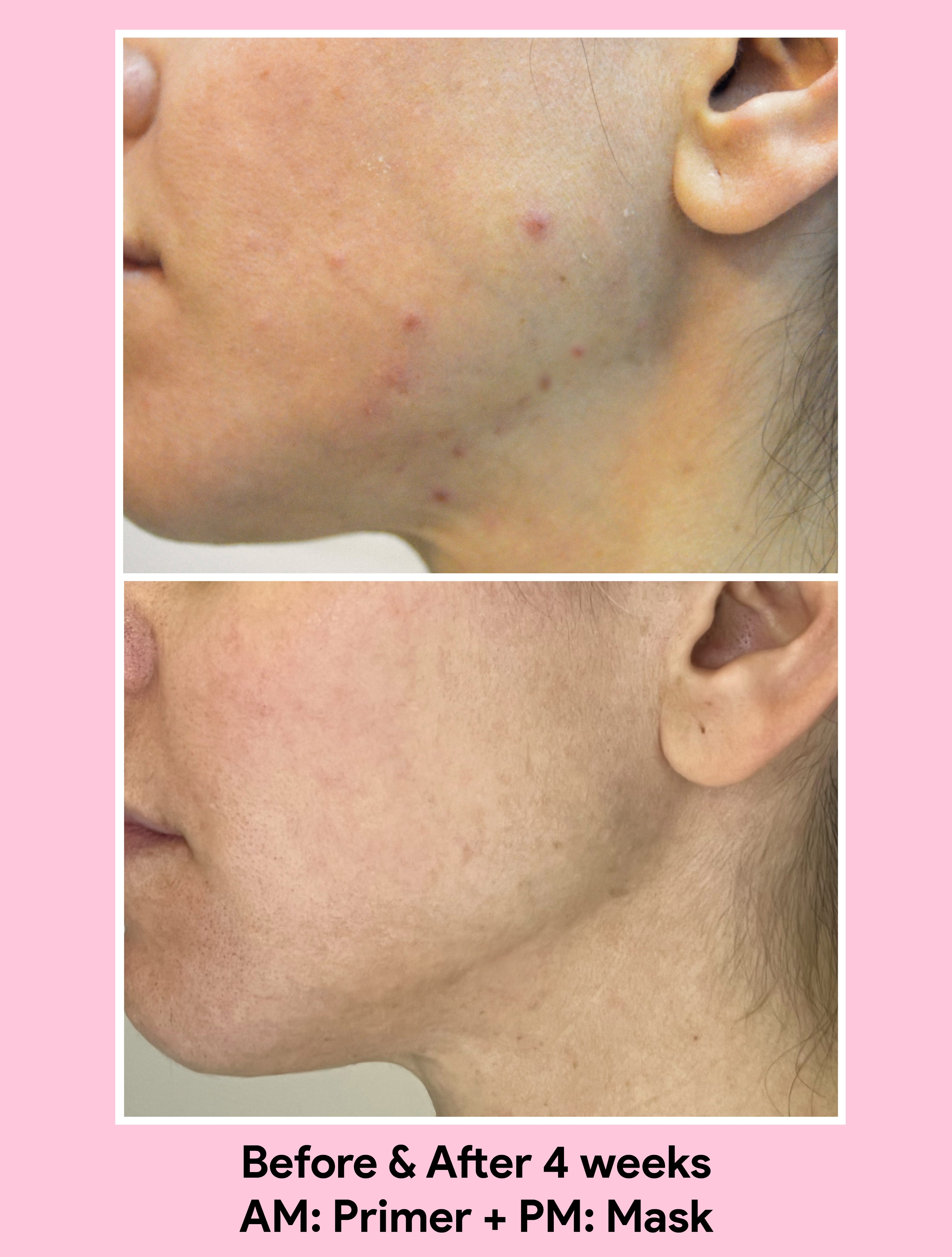 Before and After use of Jori Primer and Mask revealing clear skin after 4 weeks.