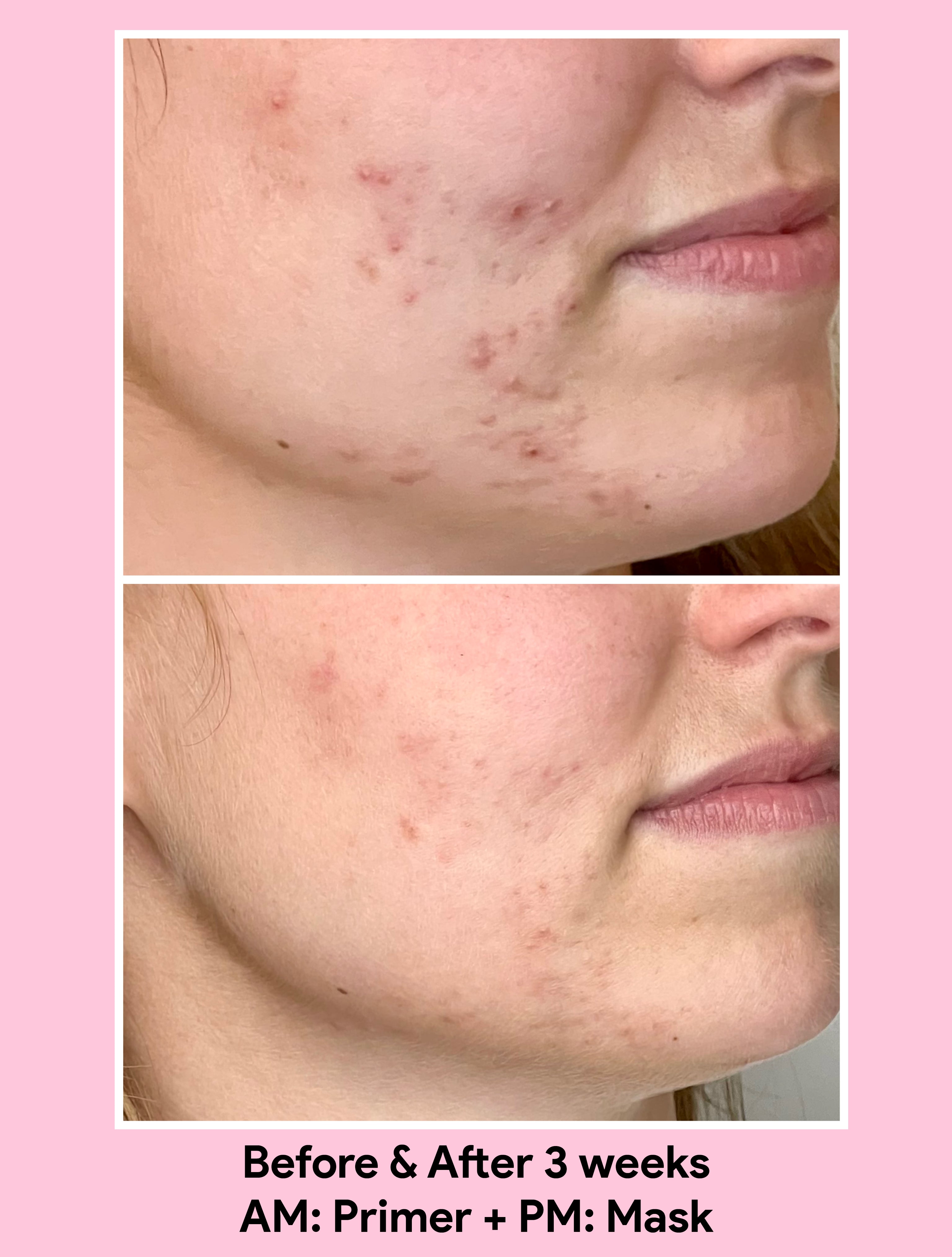 Before and After use of Jori Primer and Mask revealing clear skin after 3 weeks.